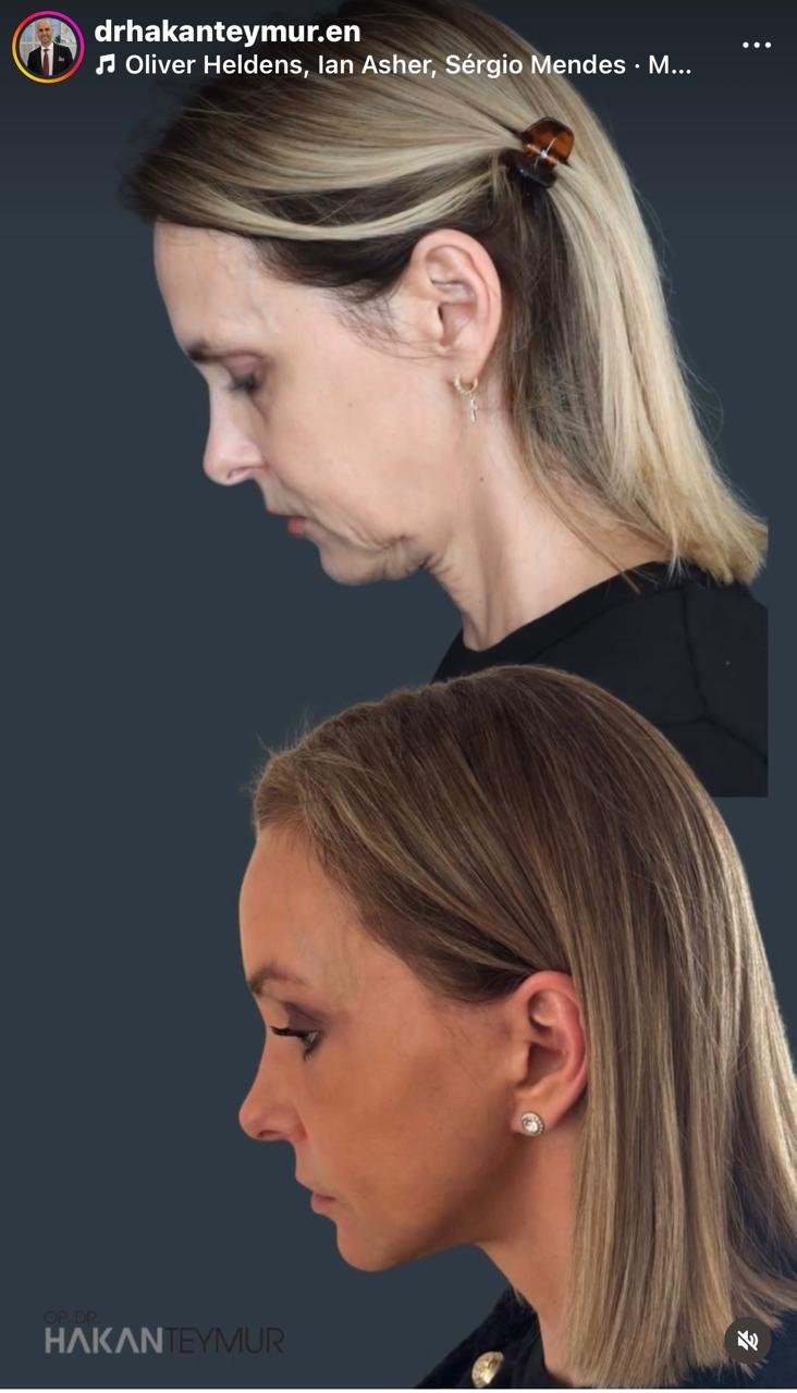 Before and after result by Dr. Hakan Teymur