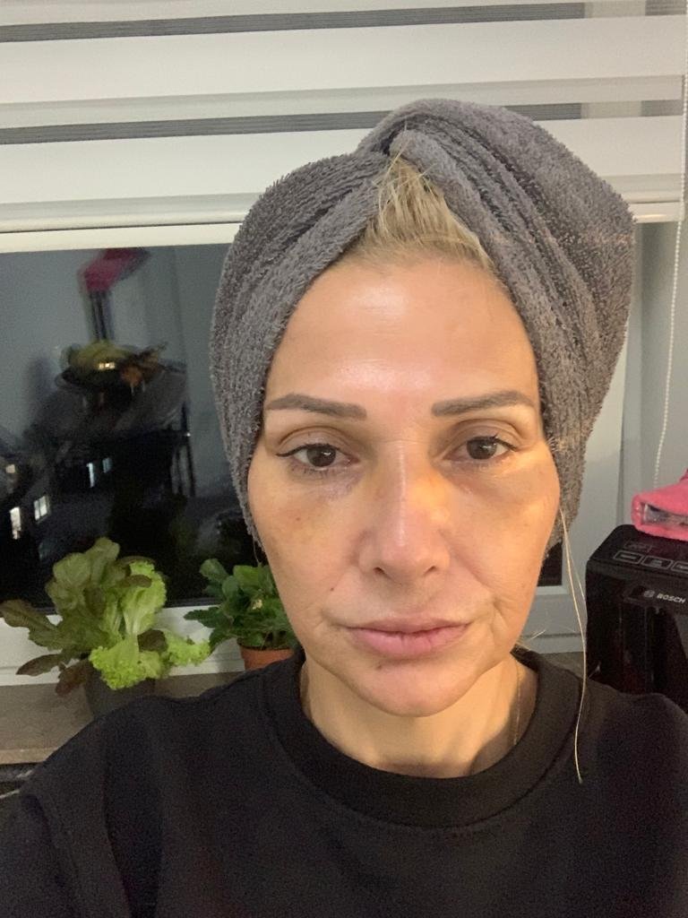 Before and after result by Dr. Hakan Teymur