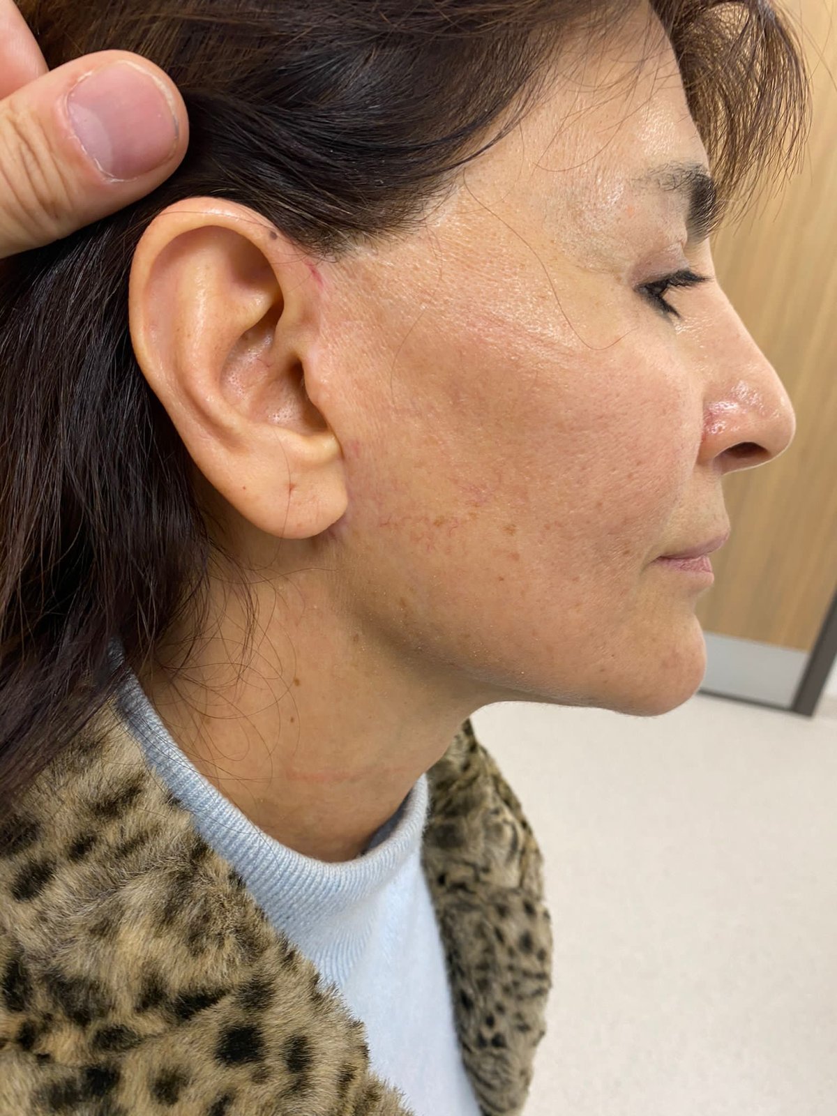 Before and after result by Dr. Hakan Teymur