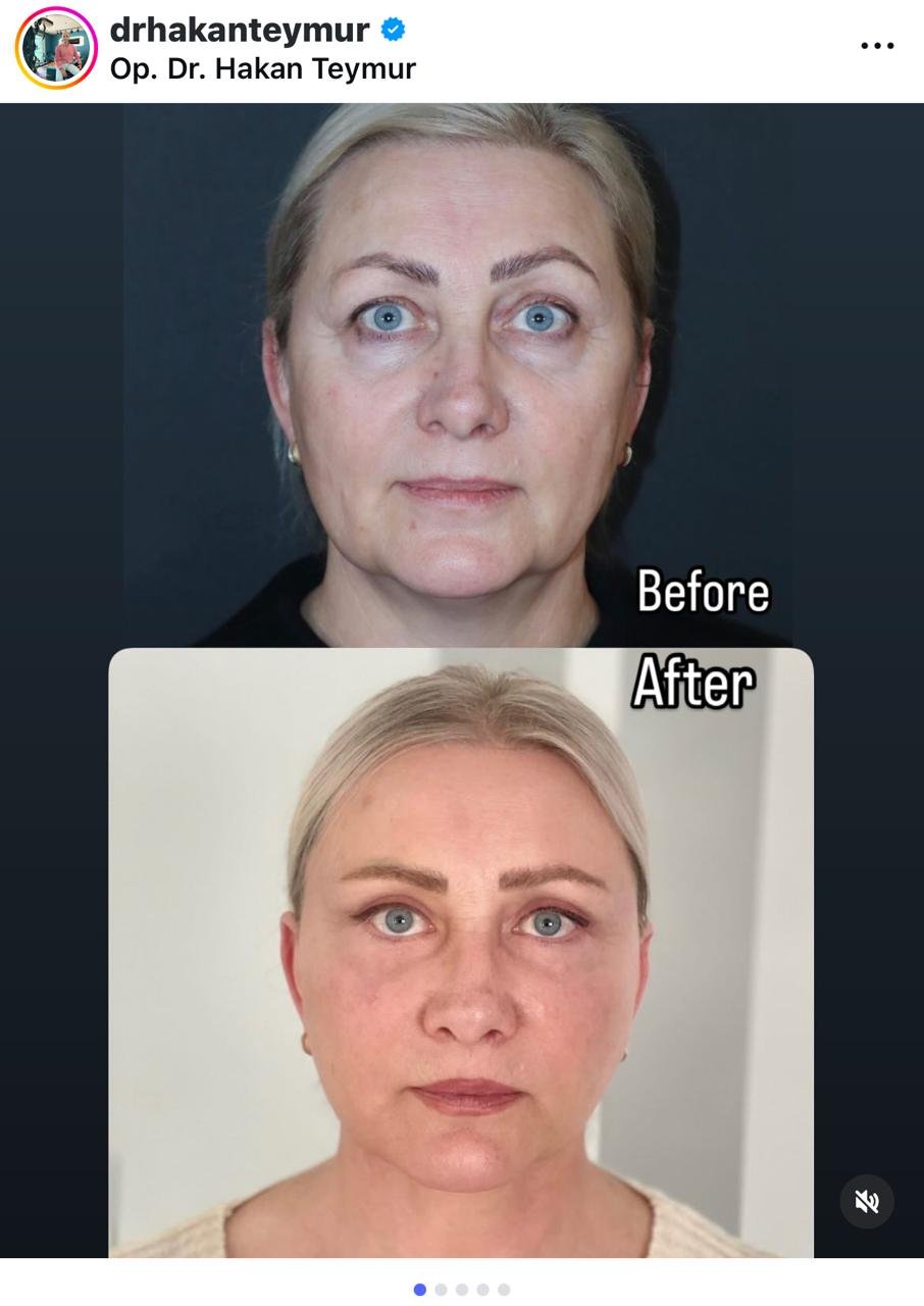 Before and after result by Dr. Hakan Teymur