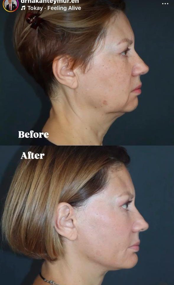Before and after result by Dr. Hakan Teymur