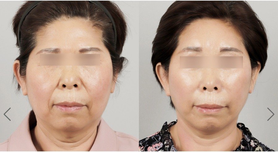Before and after result by Dr. Park Sang-Hoon