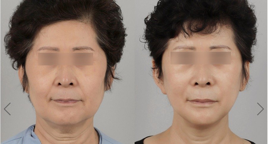 Before and after result by Dr. Park Sang-Hoon