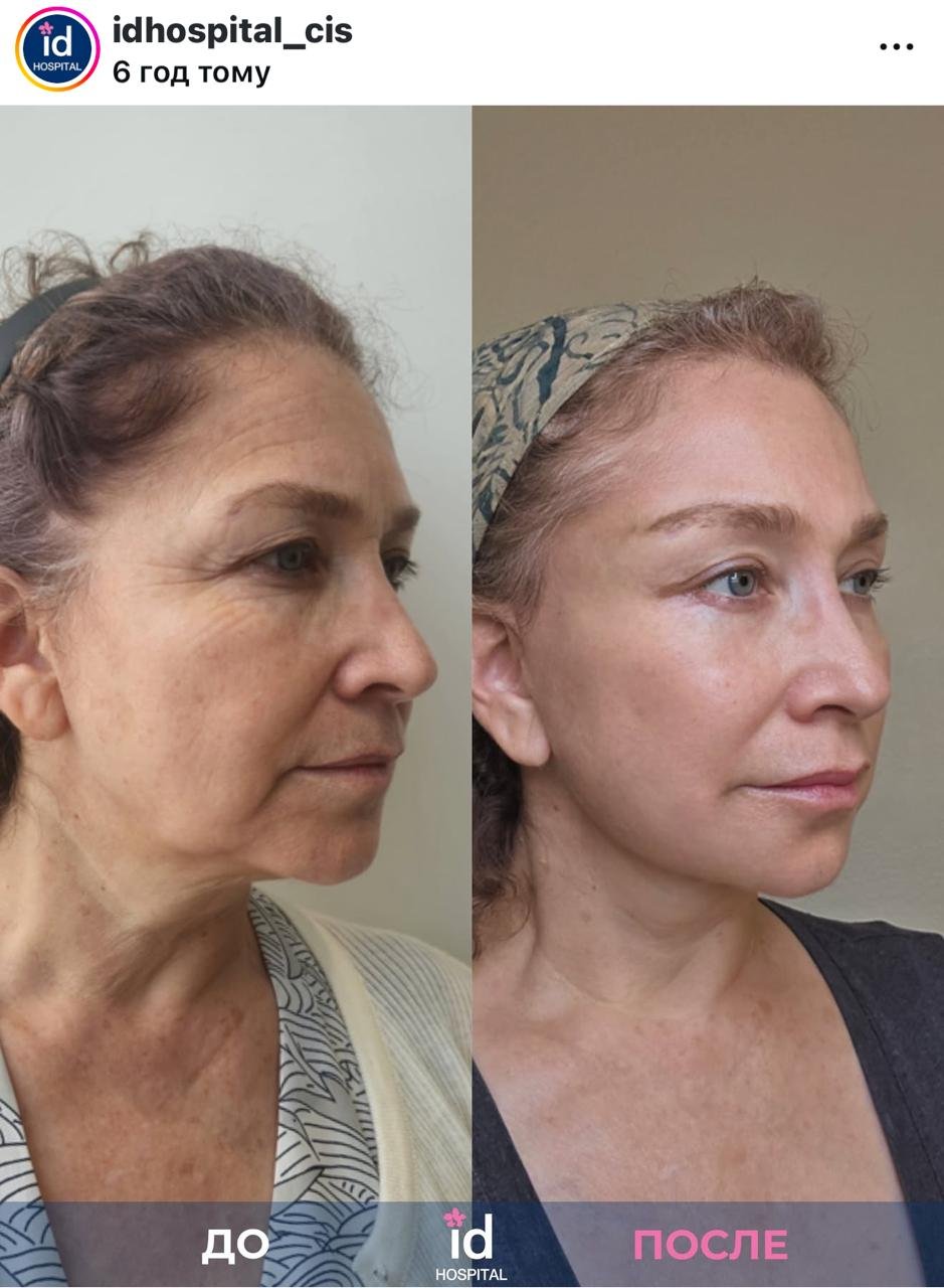 Before and after result by Dr. Park Sang-Hoon
