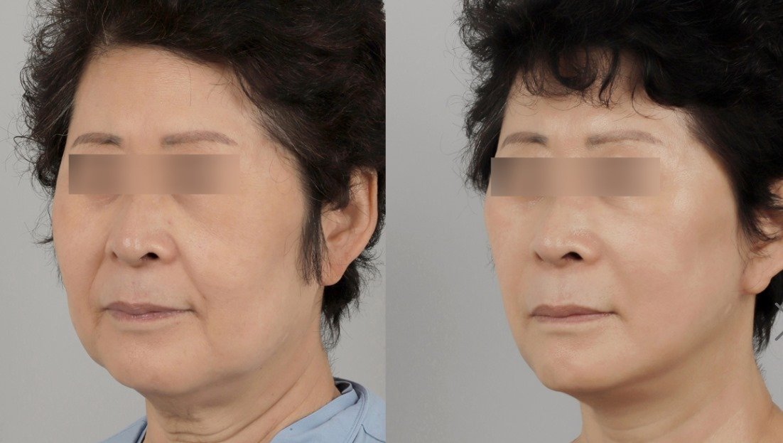 Before and after result by Dr. Park Sang-Hoon