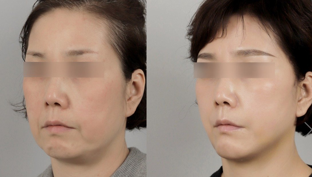 Before and after result by Dr. Park Sang-Hoon