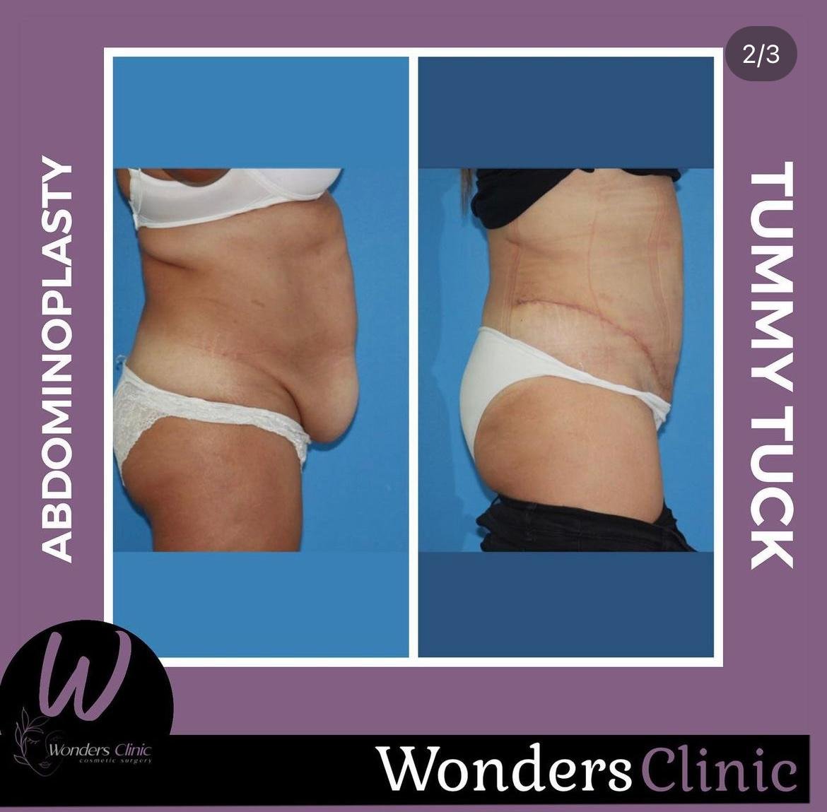 Before and after result by Dr. Yurdakul İlker Manavbasi