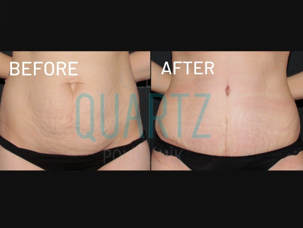 Before and after result by Dr. Leyla Arvas