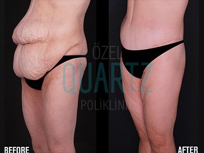 Before and after result by Dr. Aysel Pasazade