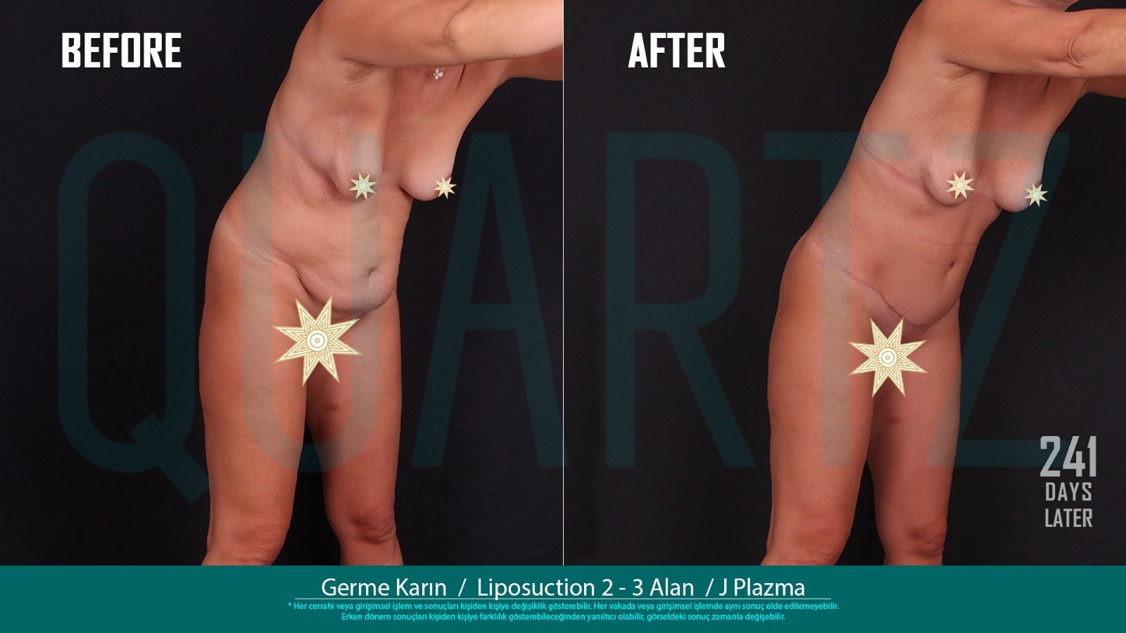 Before and after result by Dr. Aysel Pasazade