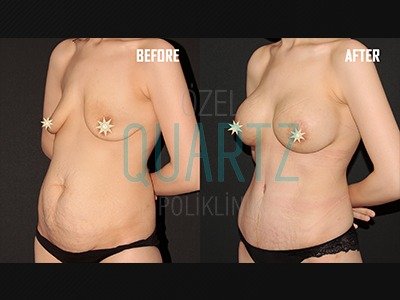 Before and after result by Dr. Leyla Arvas