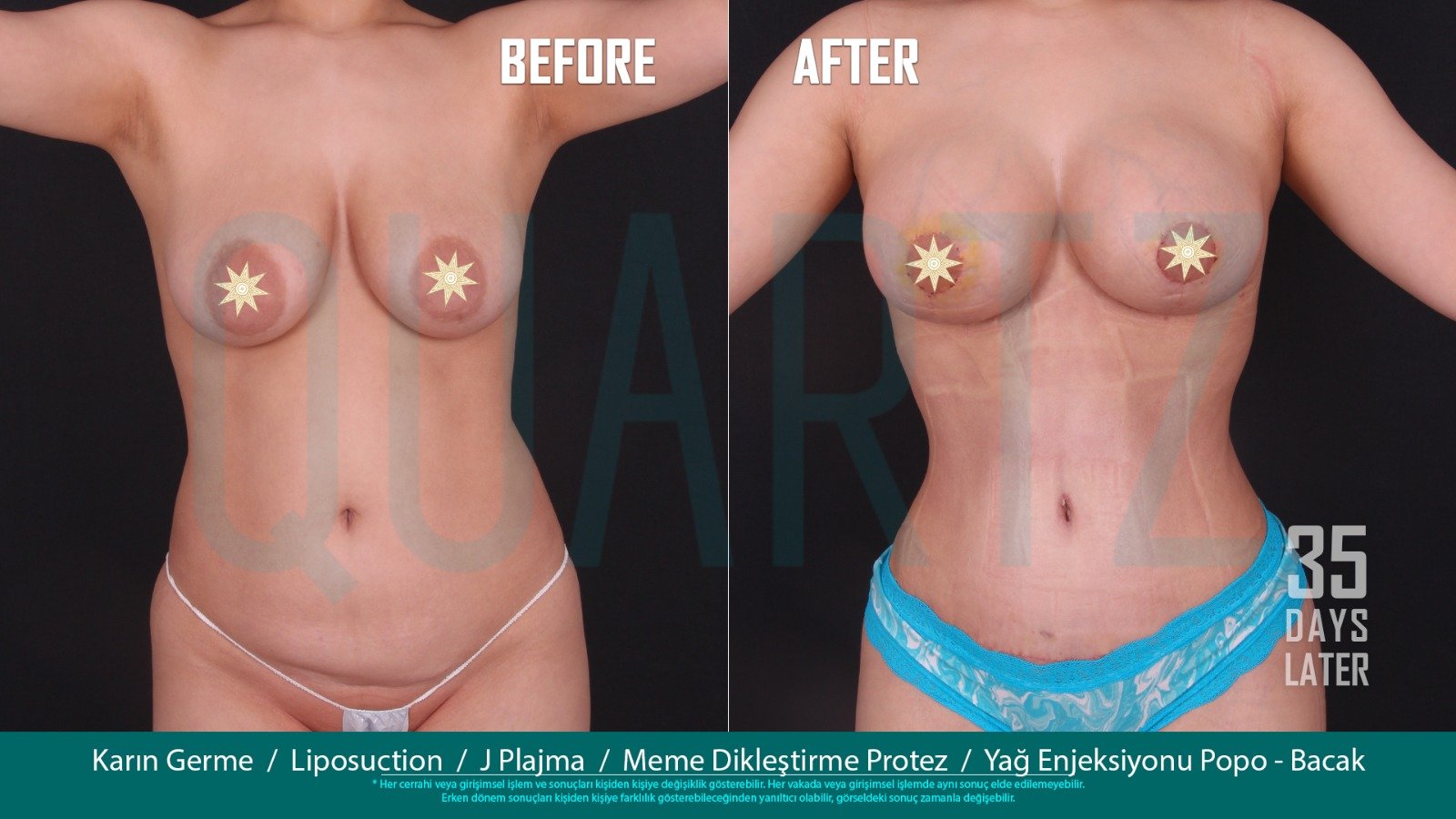 Before and after result by Dr. Aysel Pasazade