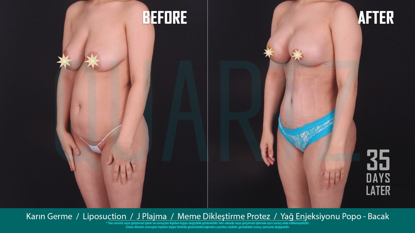 Before and after result by Dr. Leyla Arvas