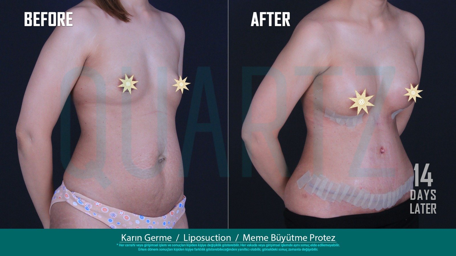 Before and after result by Dr. Aysel Pasazade