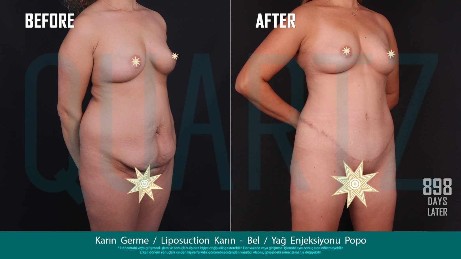 Before and after result by Dr. Leyla Arvas