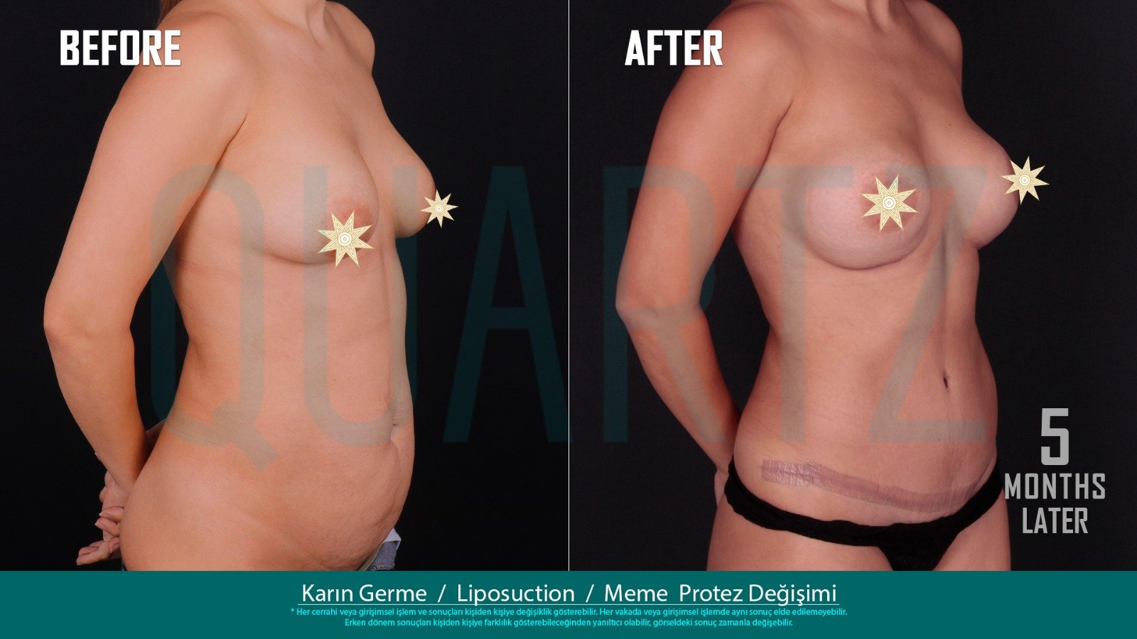 Before and after result by Dr. Aysel Pasazade