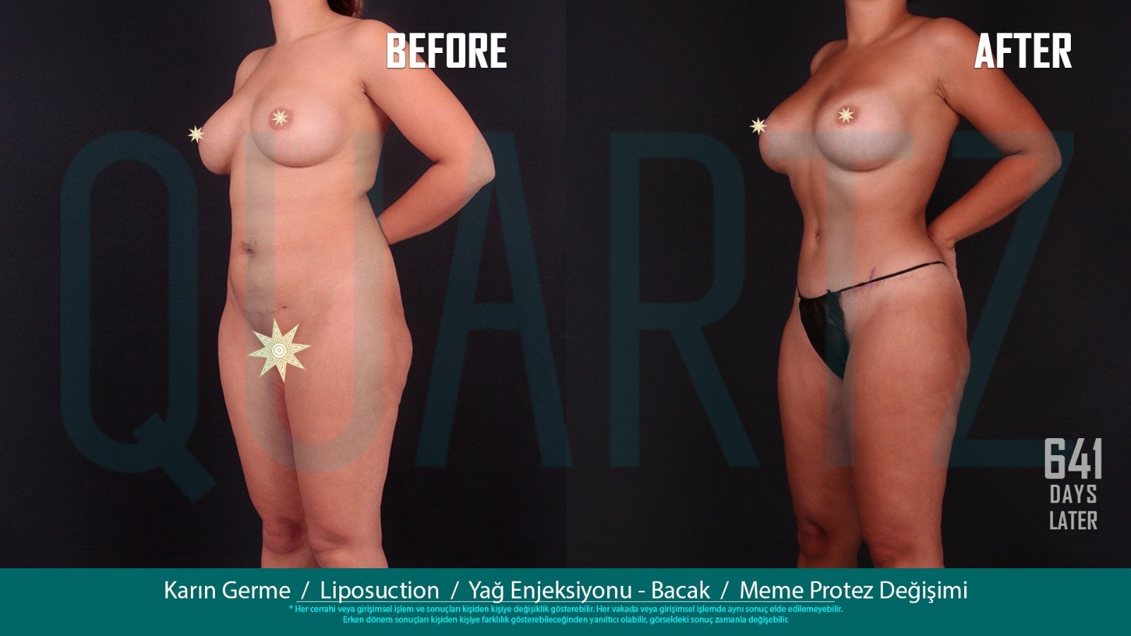 Before and after result by Dr. Leyla Arvas
