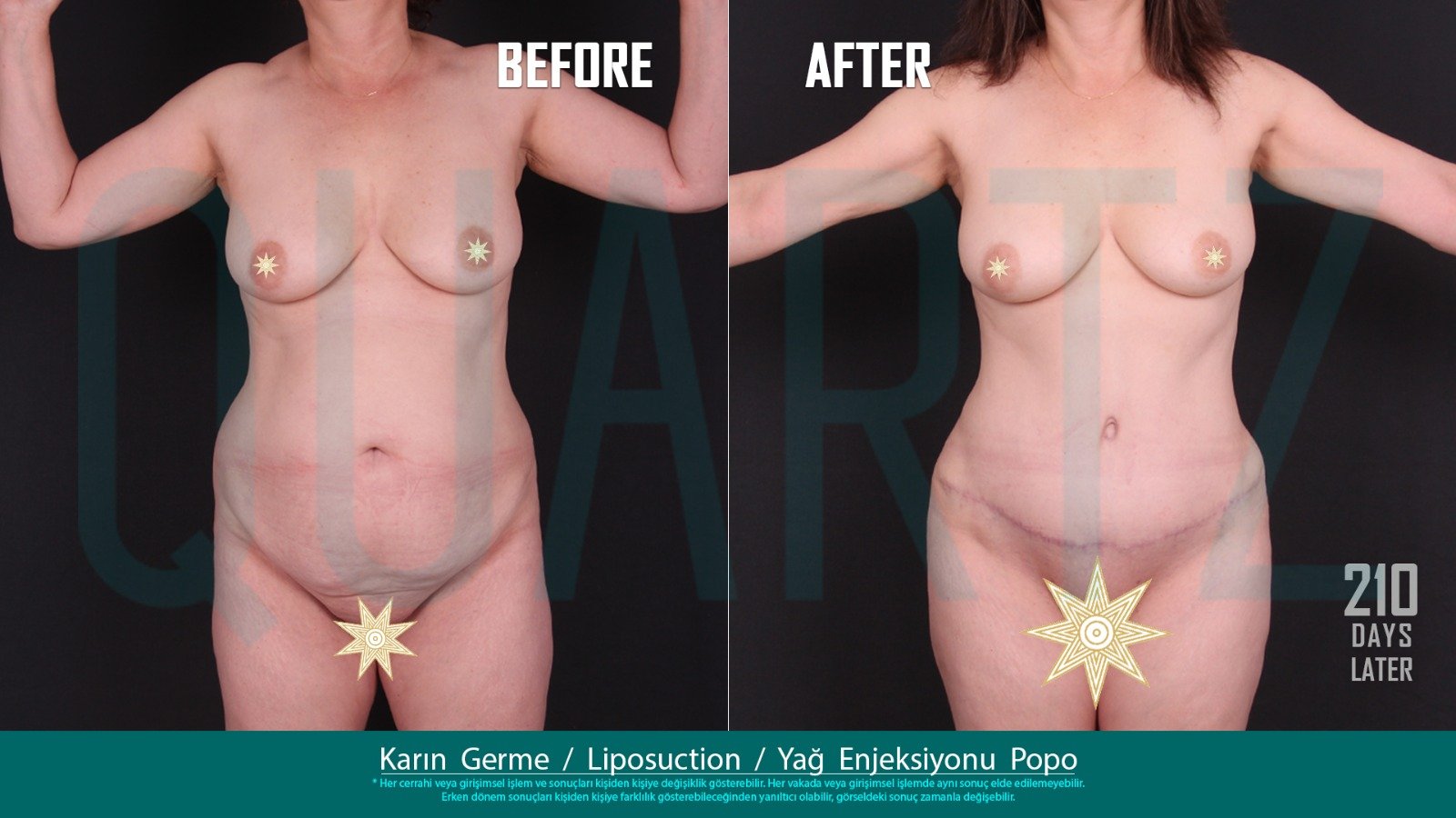 Before and after result by Dr. Aysel Pasazade