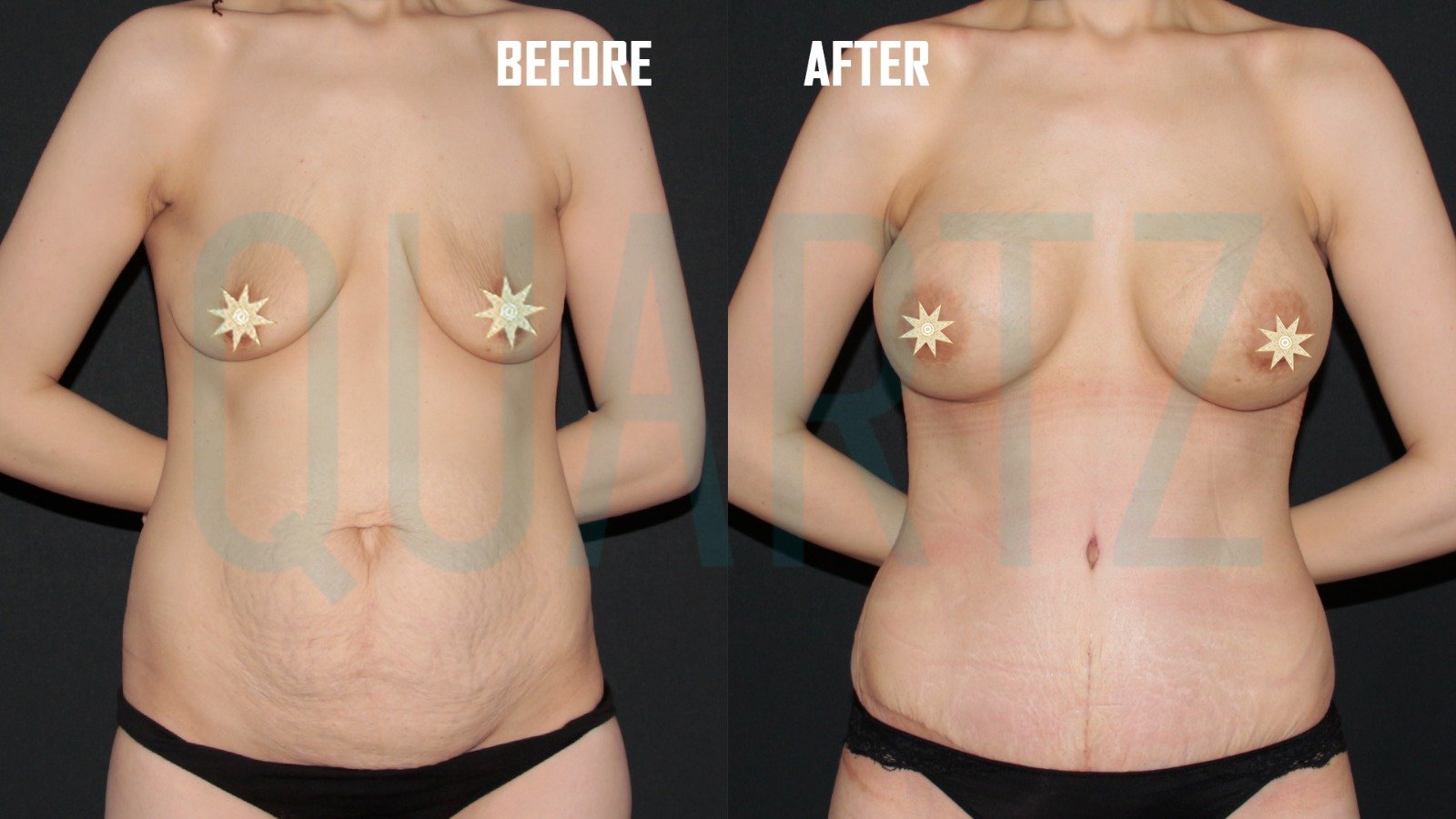 Before and after result by Dr. Leyla Arvas