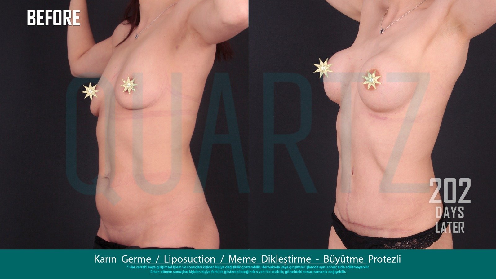 Before and after result by Dr. Aysel Pasazade