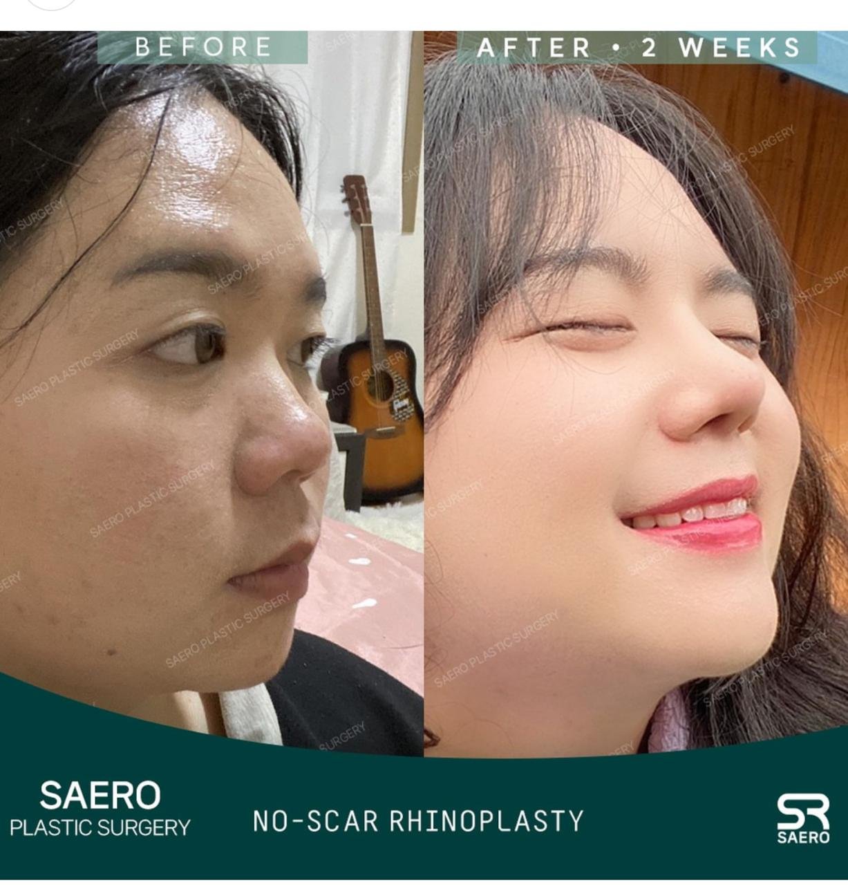 Before and after result by Dr. Park Young Kyu