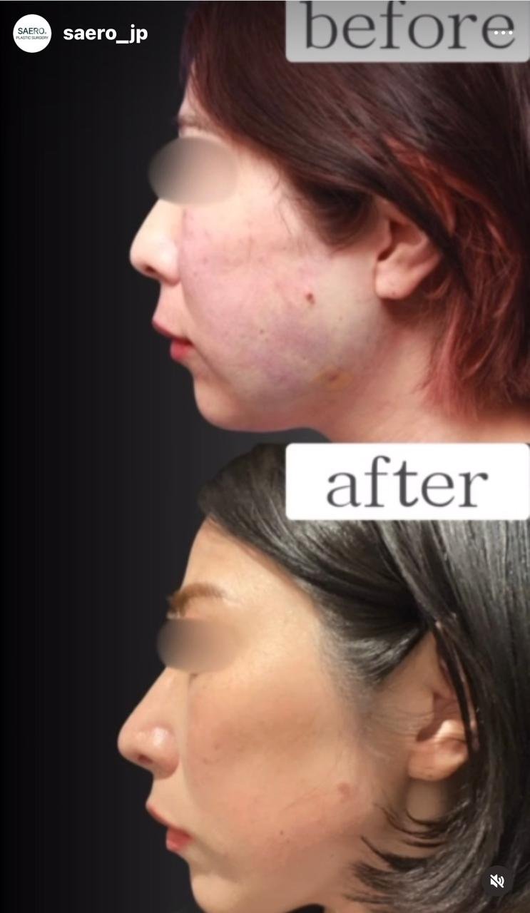 Before and after result by Dr. Park Young Kyu