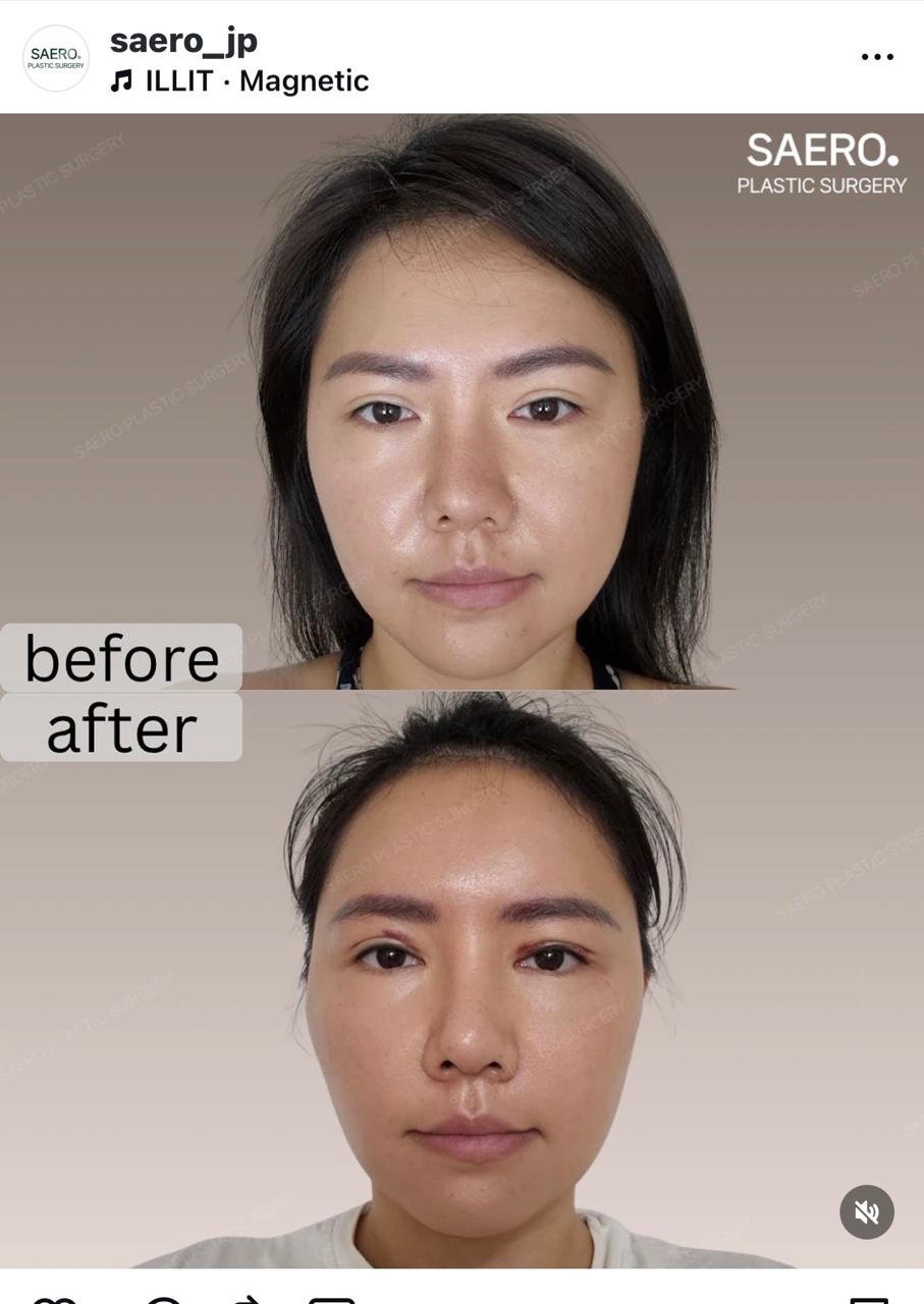 Before and after result by Dr. Park Young Kyu