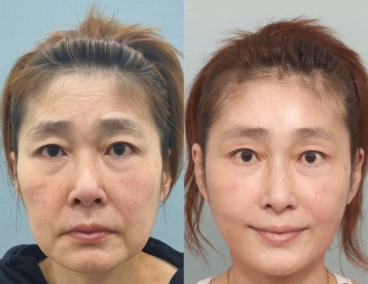 Before and after result by Dr. Park Young Kyu