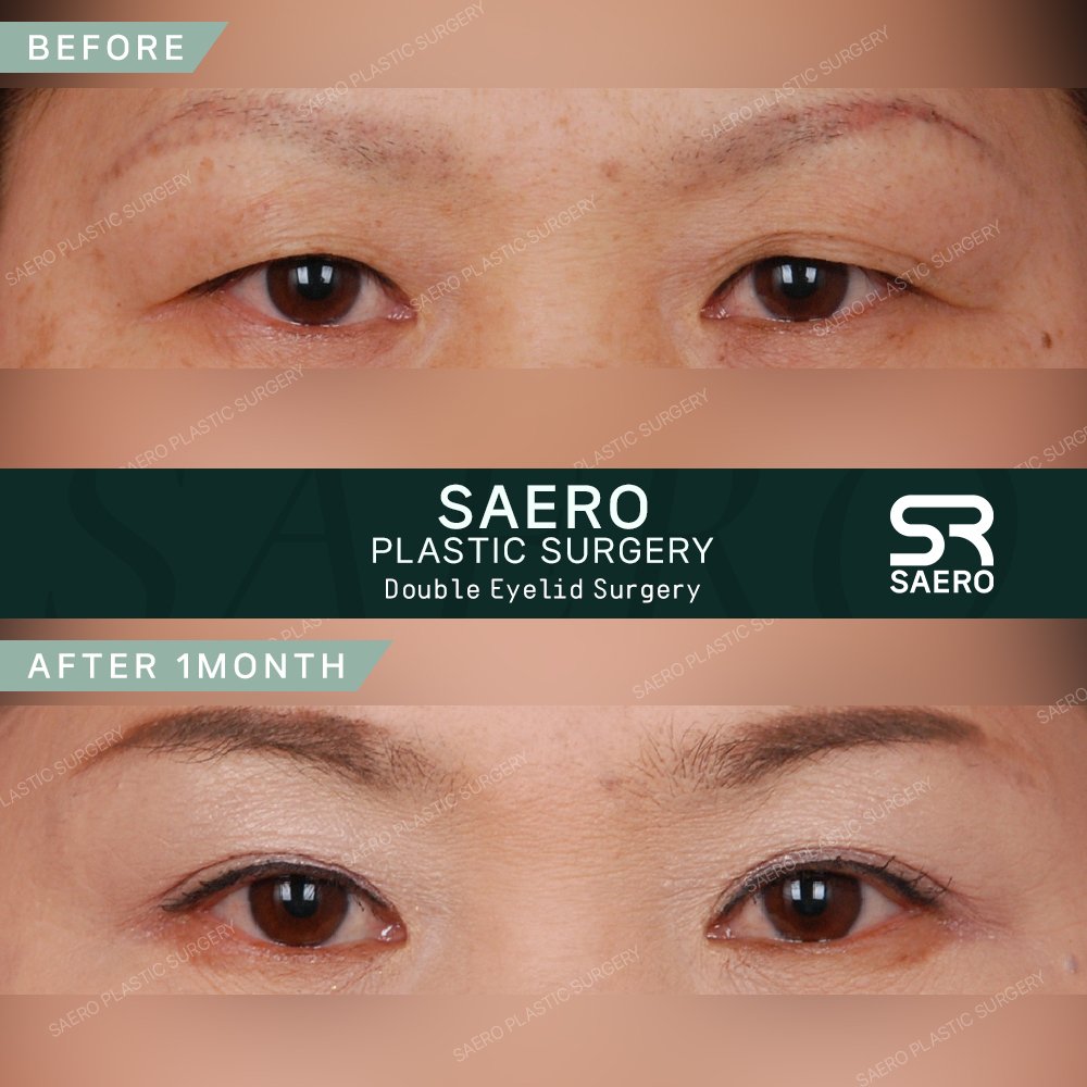 Before and after result by Dr. Park Young Kyu