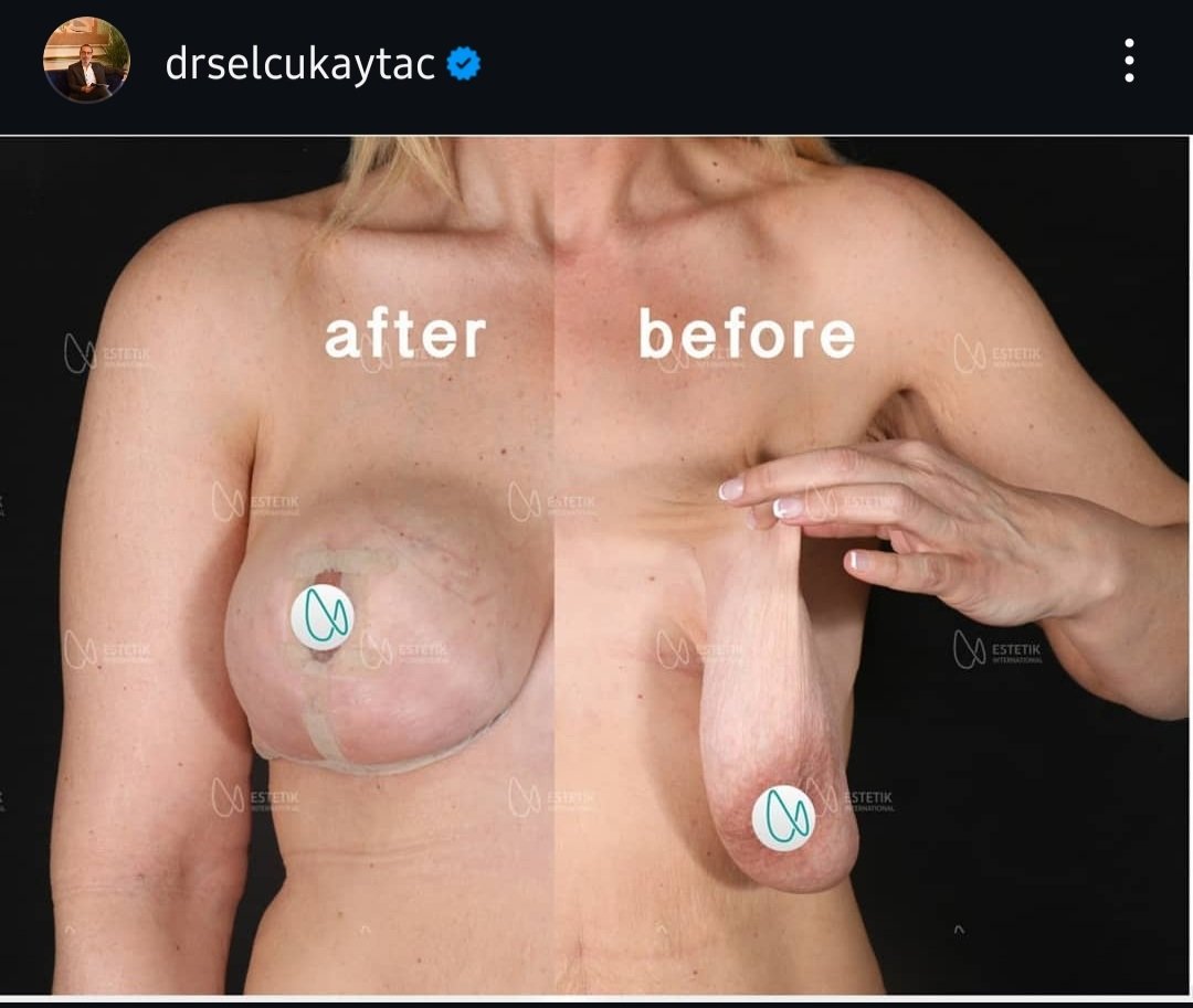 Before and after result by Dr. Selçuk Aytaç