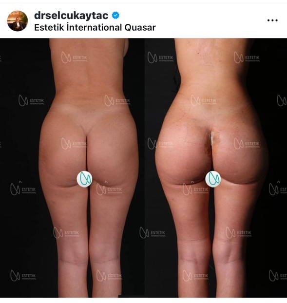 Before and after result by Dr. Selçuk Aytaç