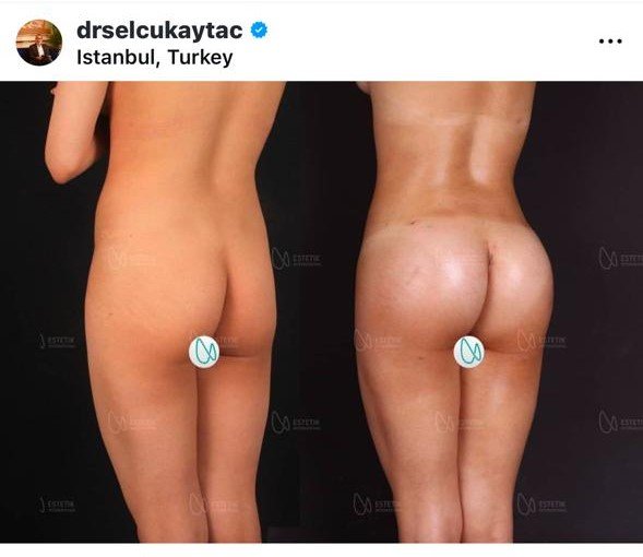 Before and after result by Dr. Selçuk Aytaç