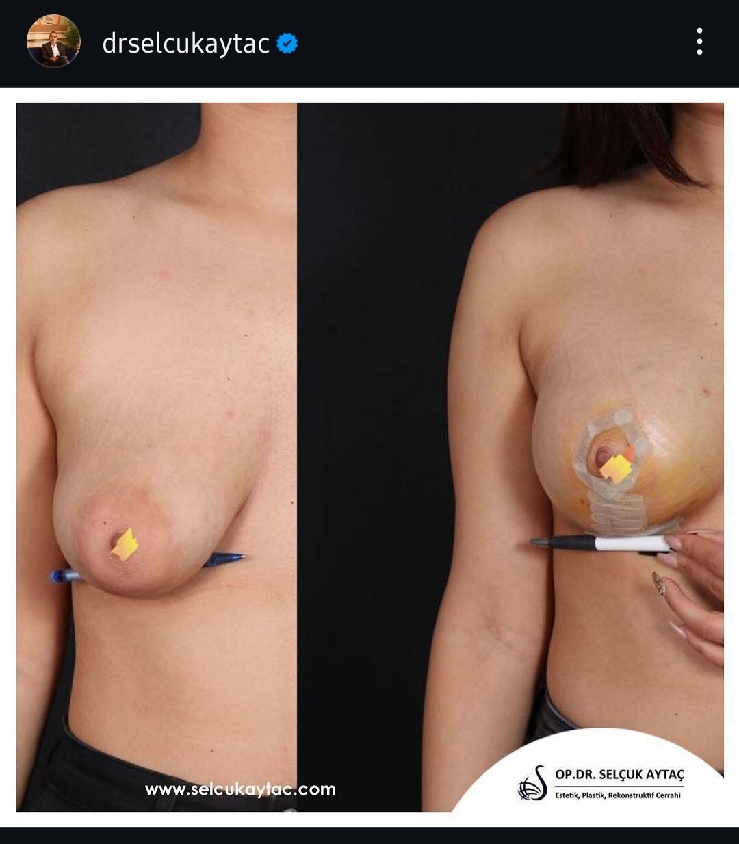 Before and after result by Dr. Selçuk Aytaç