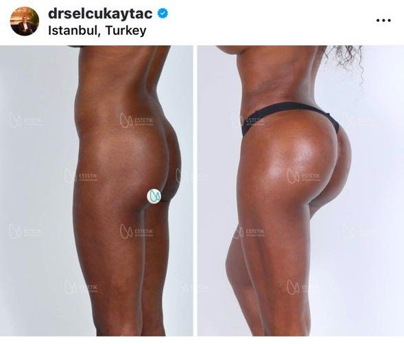 Before and after result by Dr. Selçuk Aytaç