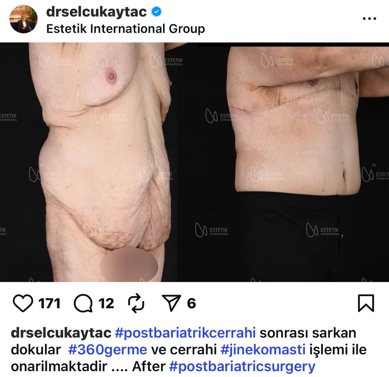 Before and after result by Dr. Selçuk Aytaç