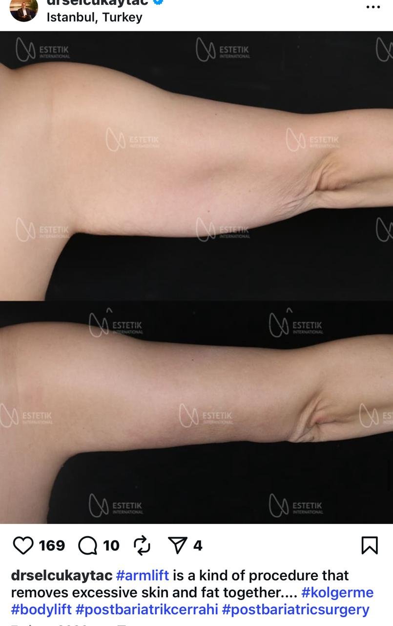 Before and after result by Dr. Selçuk Aytaç