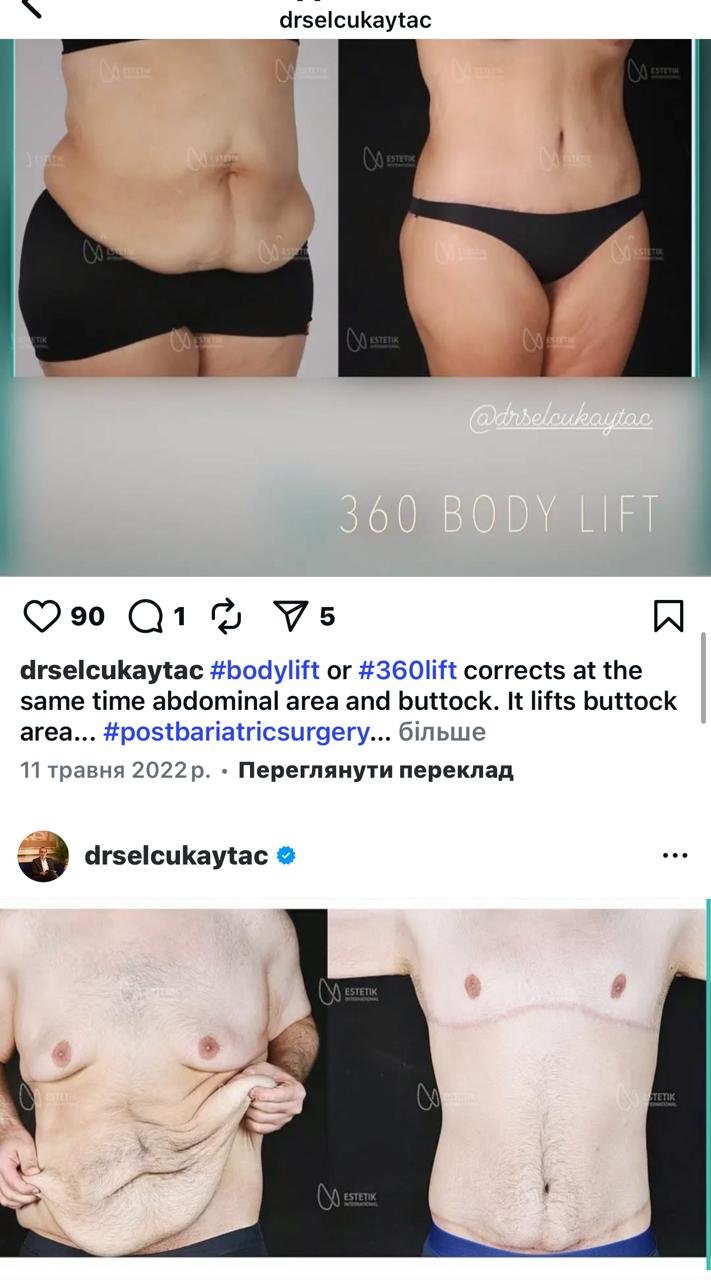 Before and after result by Dr. Selçuk Aytaç