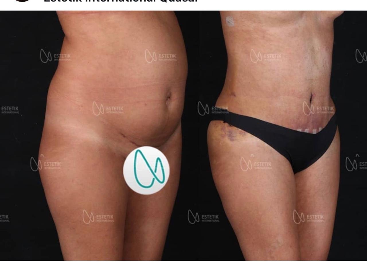 Before and after result by Dr. Selçuk Aytaç