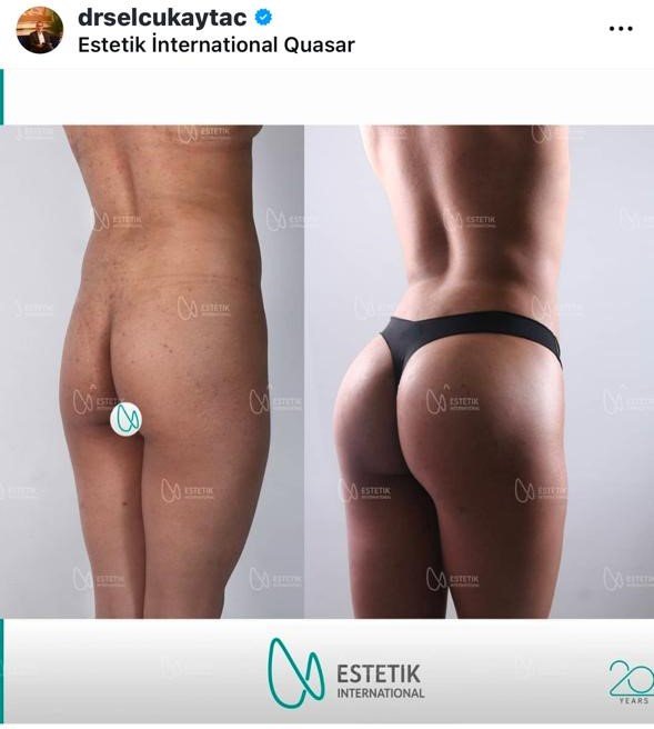 Before and after result by Dr. Selçuk Aytaç