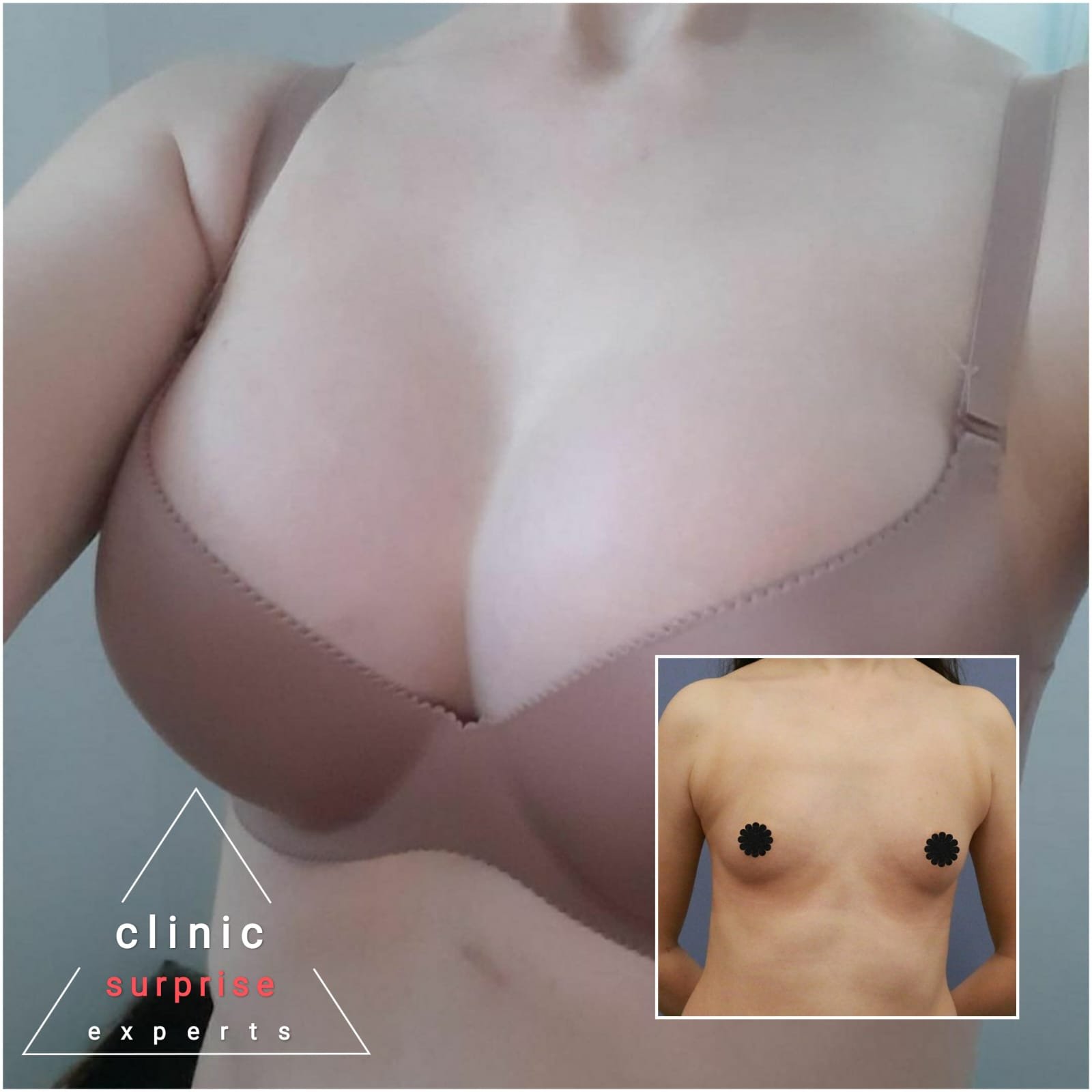 Before and after result by Dr. Taha Sönmez