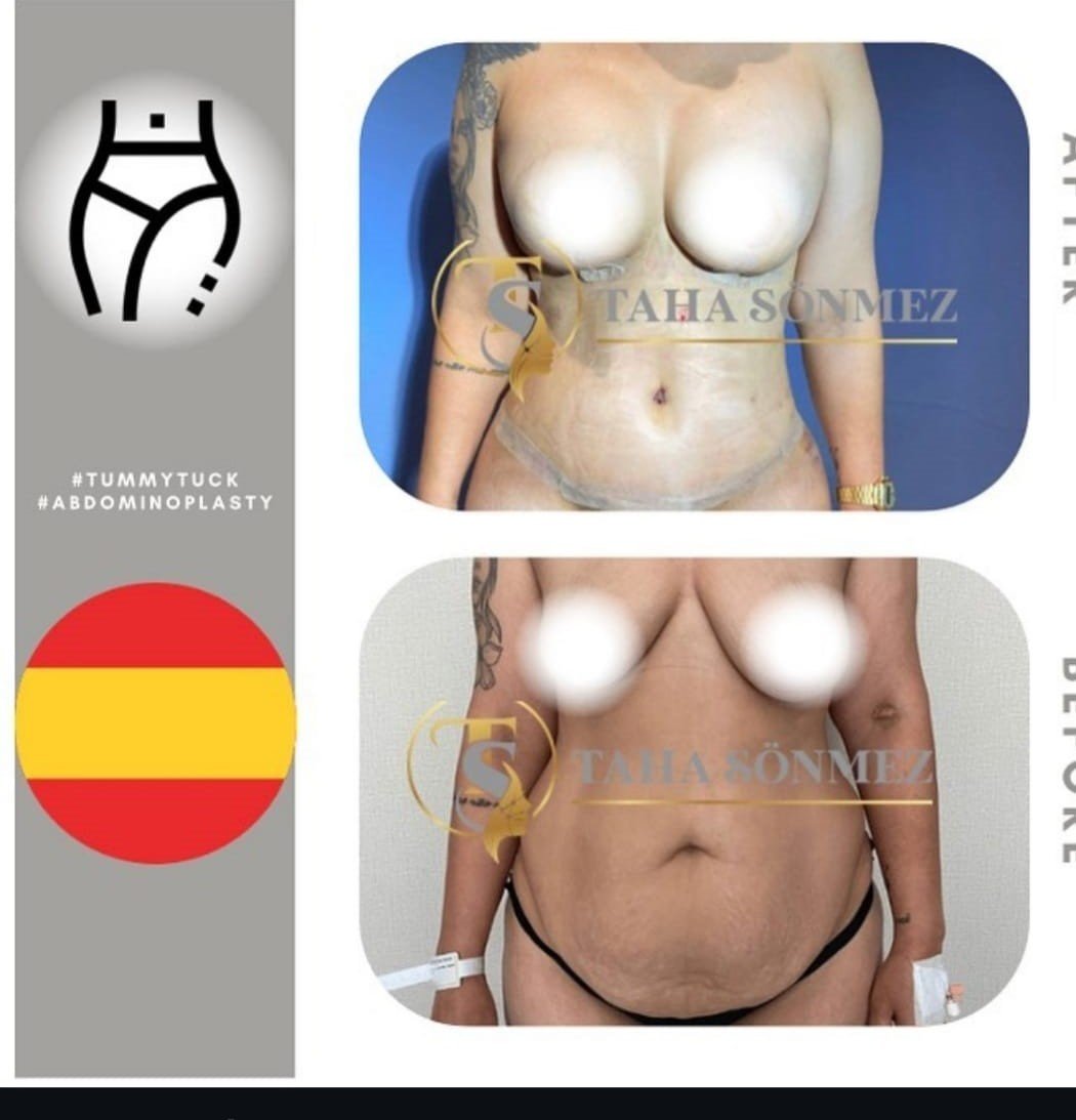 Before and after result by Dr. Taha Sönmez