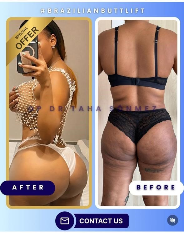 Before and after result by Dr. Taha Sönmez