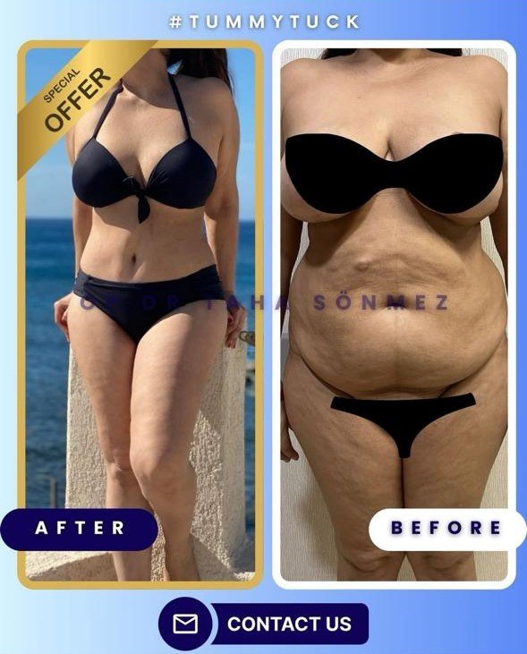 Before and after result by Dr. Taha Sönmez