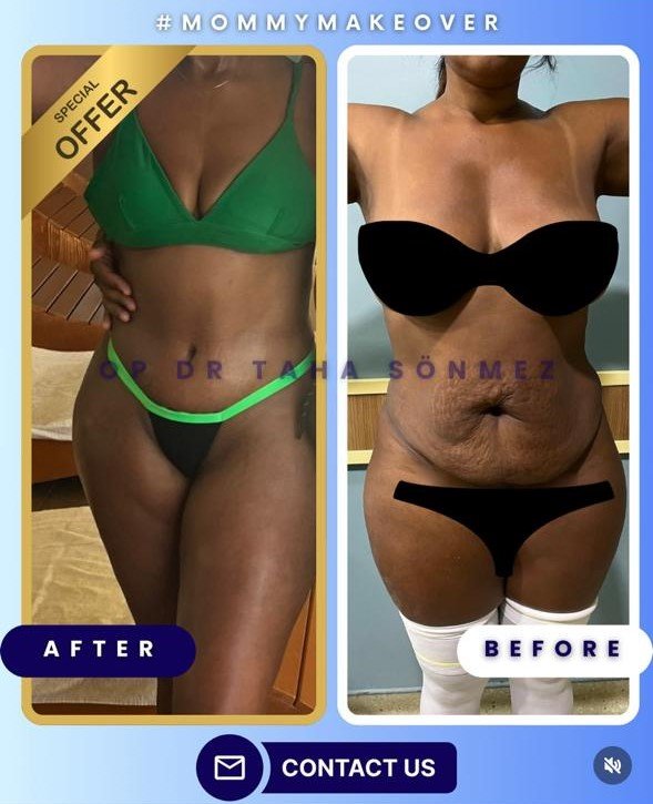 Before and after result by Dr. Taha Sönmez