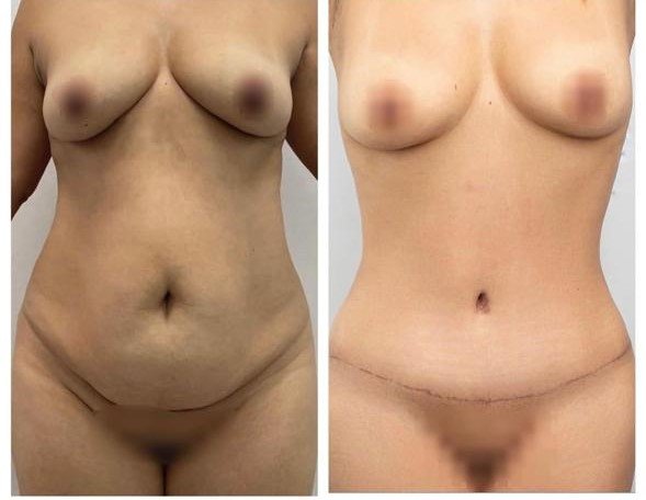 Before and after result by Dr. Taha Sönmez