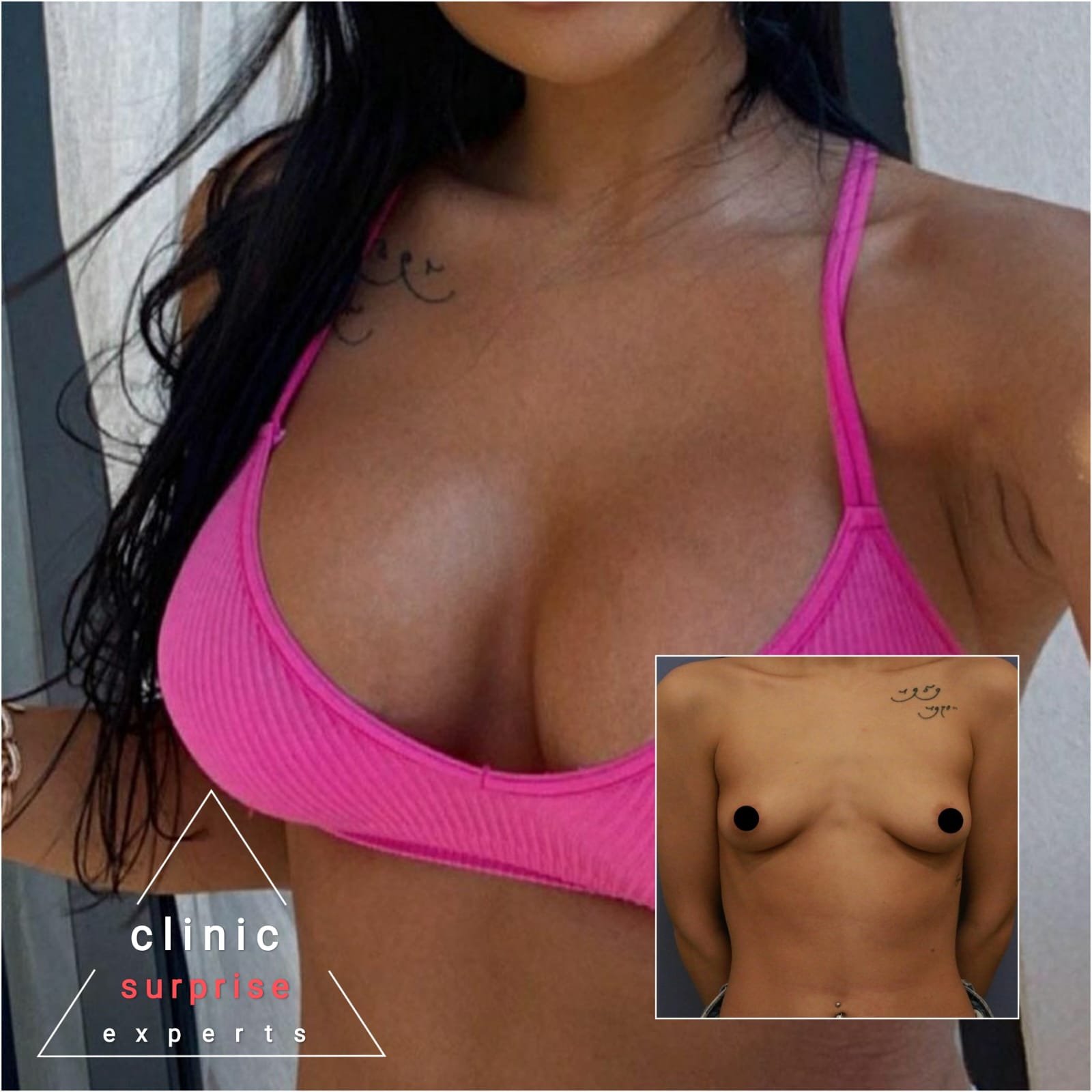 Before and after result by Dr. Taha Sönmez
