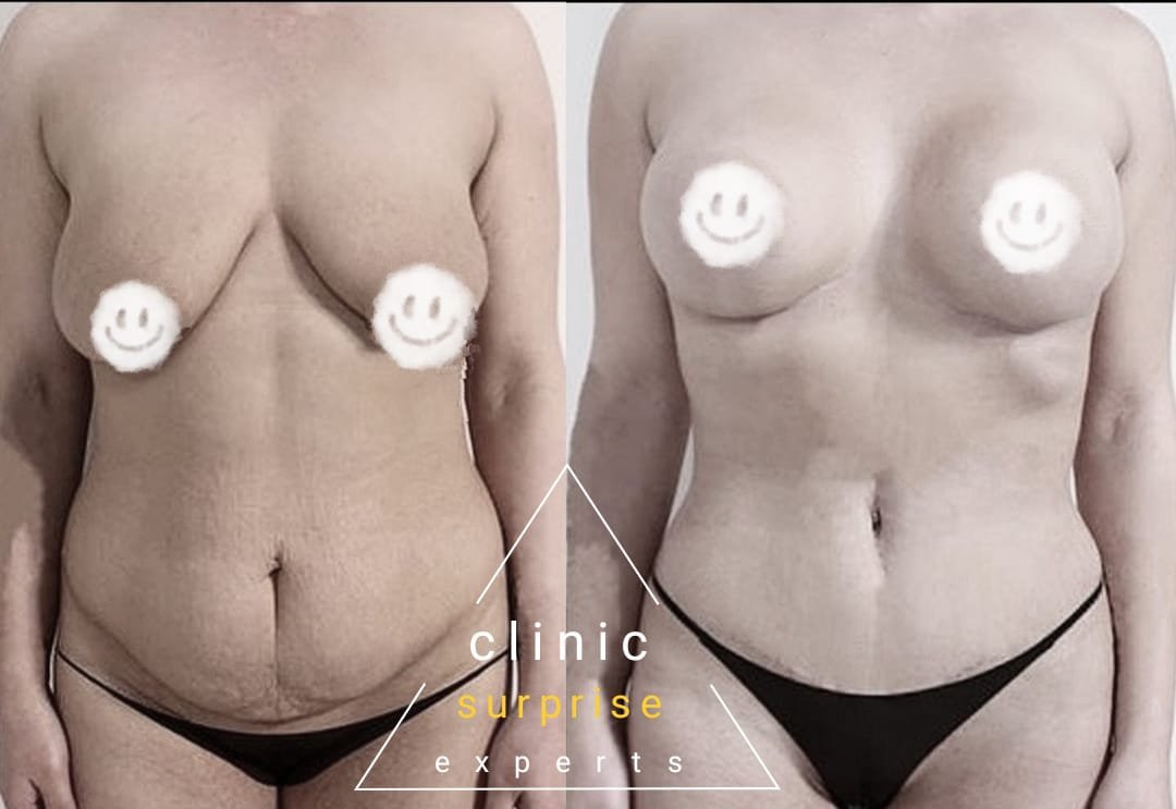 Before and after result by Dr. Taha Sönmez