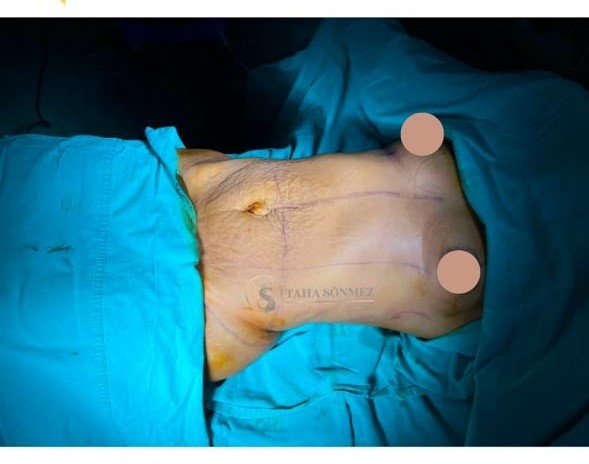 Before and after result by Dr. Taha Sönmez