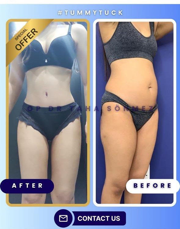 Before and after result by Dr. Taha Sönmez