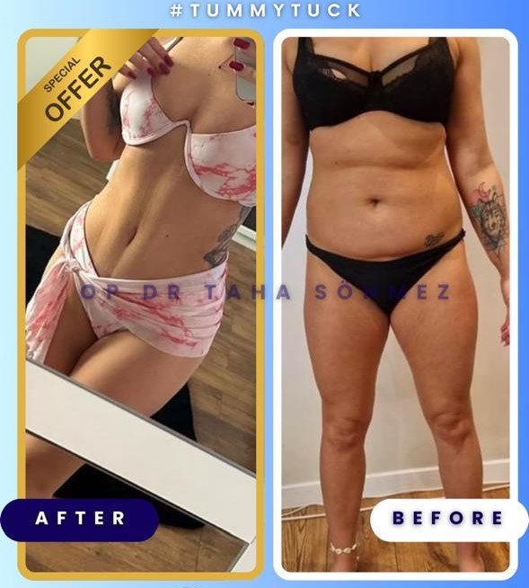 Before and after result by Dr. Taha Sönmez